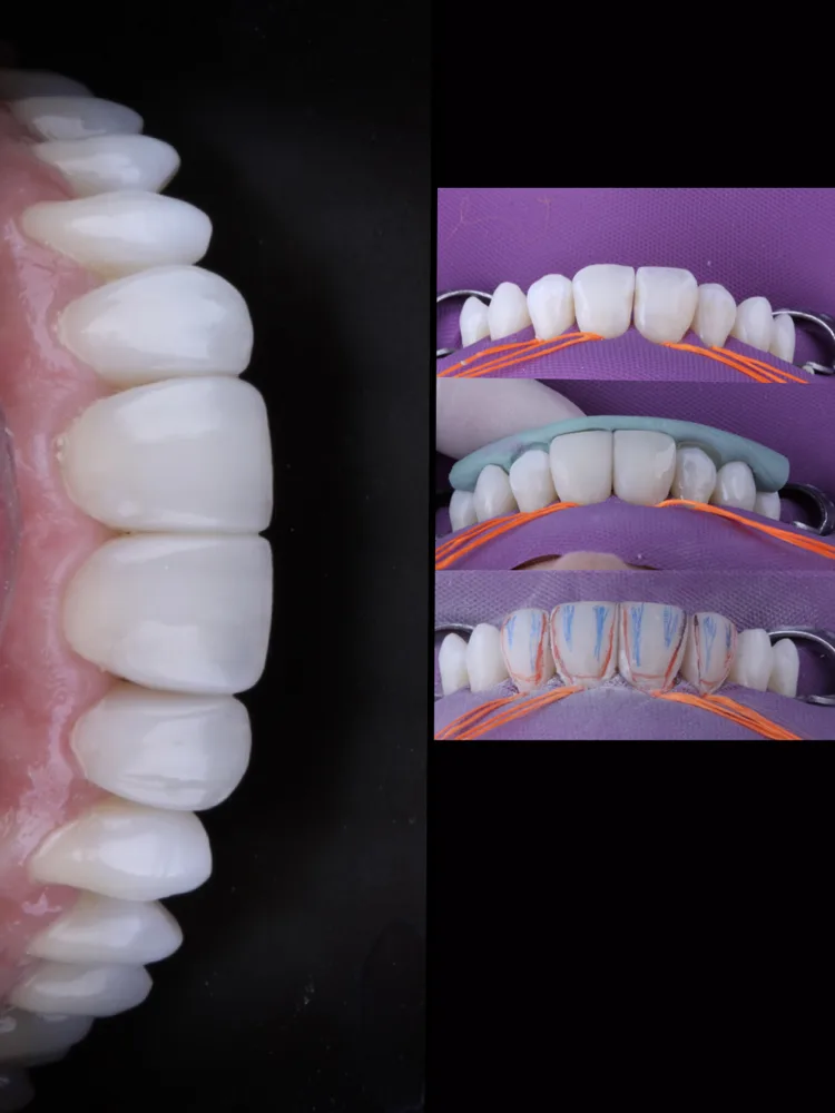 Antes e depois de recontorno em resina composta: sorriso de frente com dentes de formato mais harmônico
