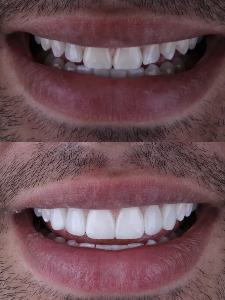 Antes e depois de harmonização do sorriso em resina composta: sorriso de frente com os dentes mais brancos, uniformes e proporcionais