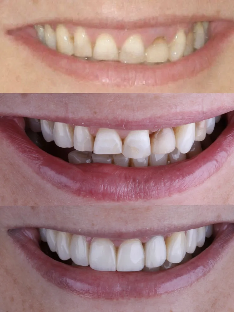 Antes e depois de ortodontia, clareamento e facetas em resina: sorriso com dentes escurecidos e irregulares que ficou branco e uniforme