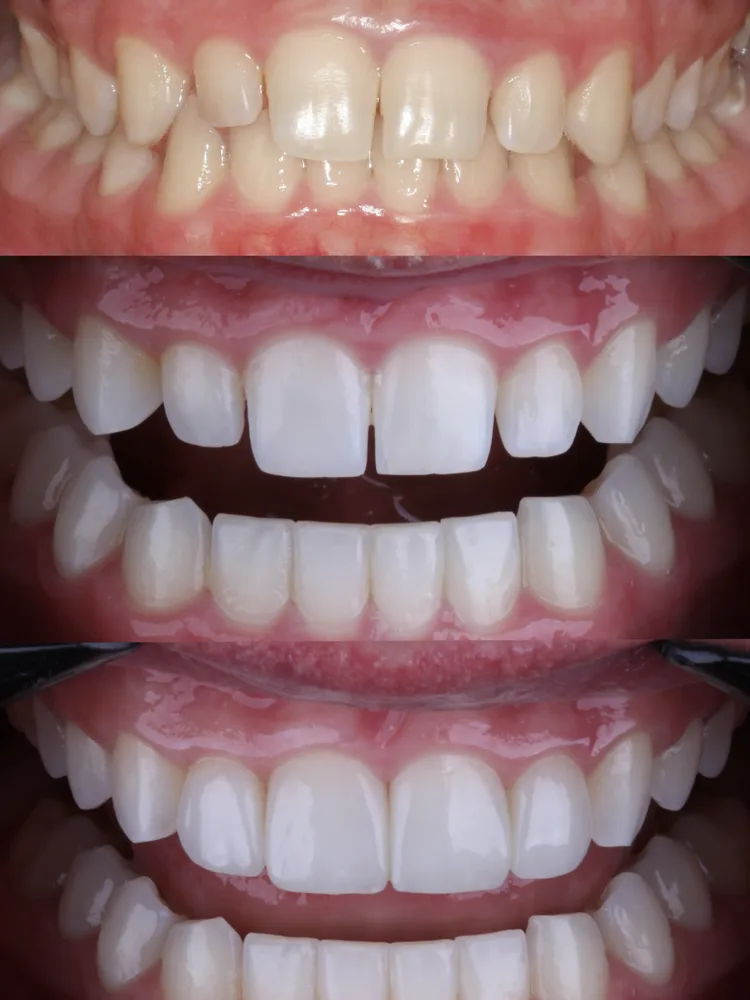 Etapas de tratamento com ortodontia, clareamento e resina composta: dentes desalinhados e amarelados, depois alinhados e, por fim, com o sorriso final harmônico